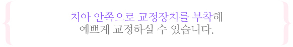 설측교정이란?