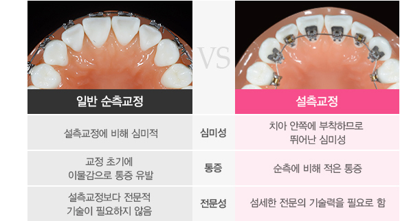 일반순측교정 vs 설측교정