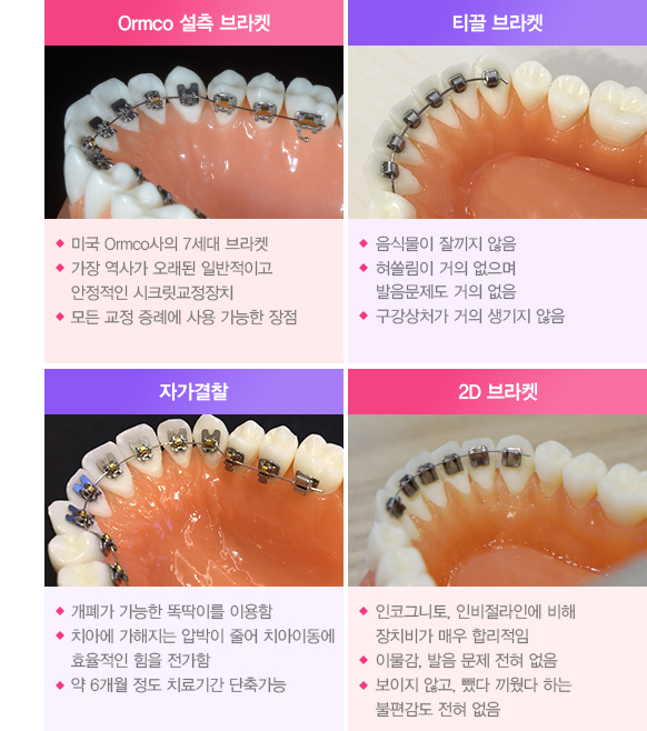 설측교정 치료과정