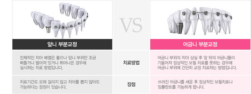 앞니부분교정VS어금니부분교정