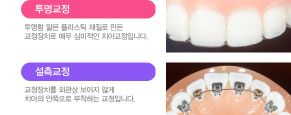 치아교정 서울베스트치과 장치별특징