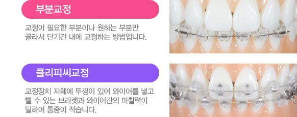 치아교정 서울베스트치과 장치별특징