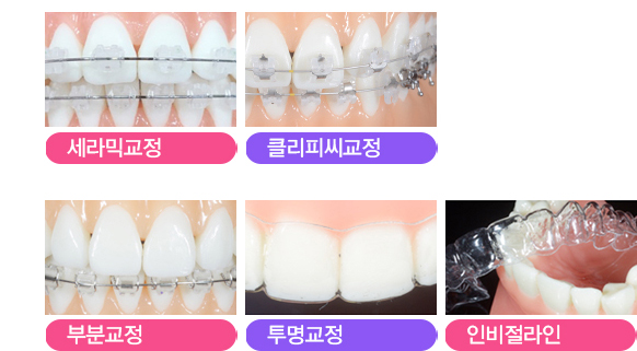 돌출입교정