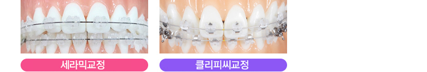 돌출입교정