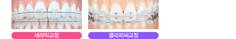 뻐드렁니교정